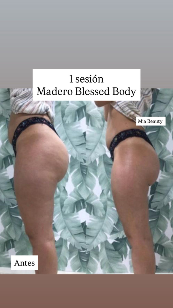 Maderoterapia