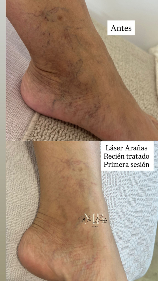 Láser para Arañas Vasculares